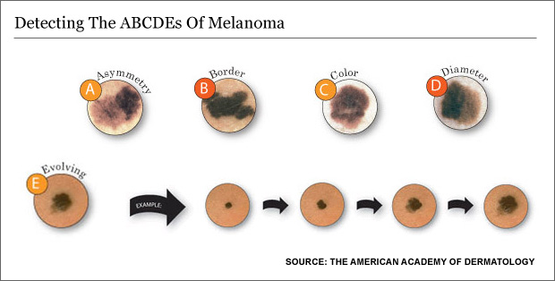 melanoma-composite_6201