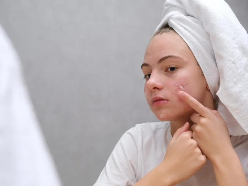 mulher a colocar creme para eliminar marcas de acne