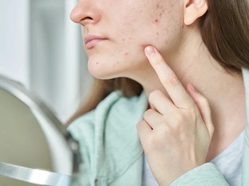 Rapariga adolescente a ver ao espelho o seu problema de pele com acne