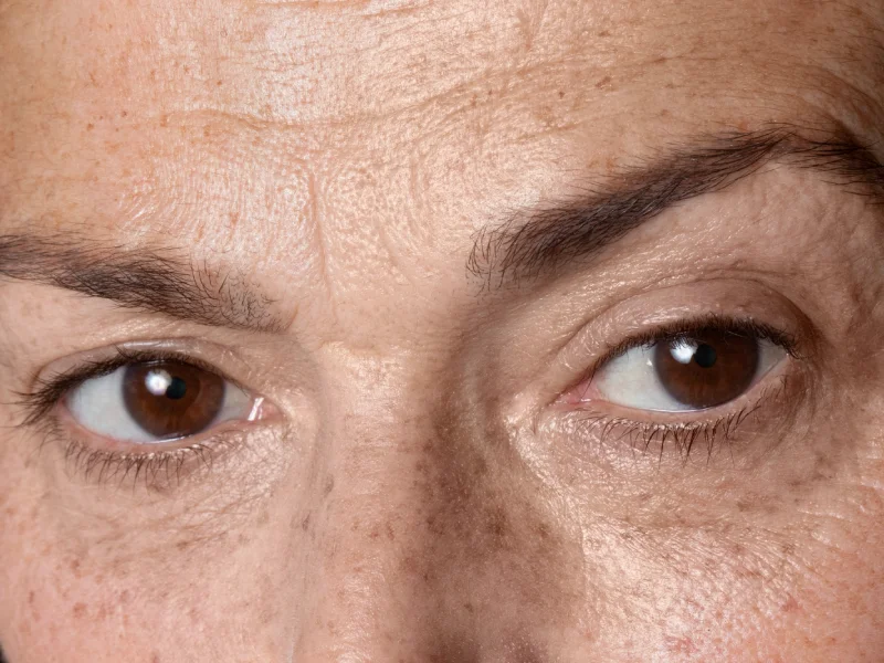 foto próxima de um rosto com irregularidades de pigmentação