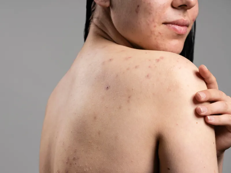 mulher com acne nas costas