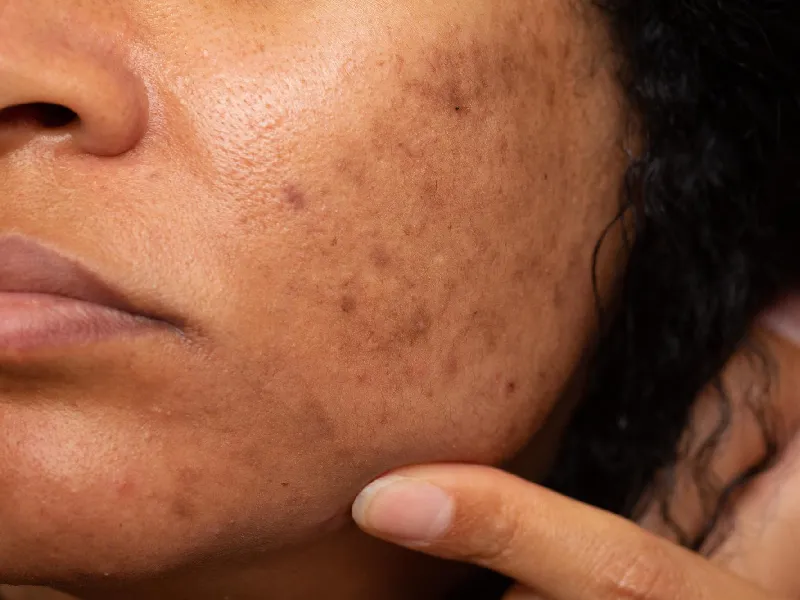mulher de pele negra com sinais de melasma