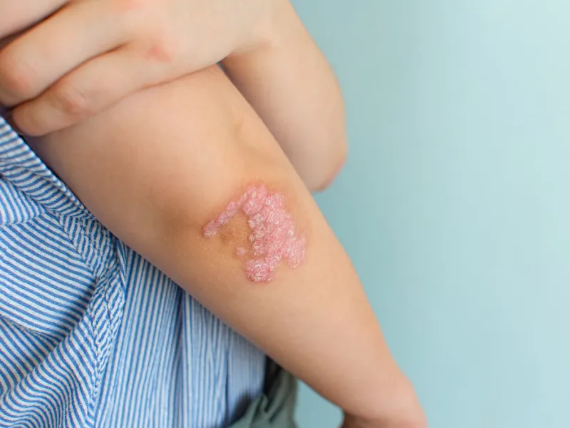 foto próxima de um cotovelo que ilustra o tipo de psoríase em placas