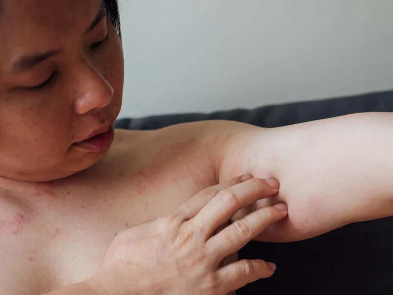 homem com sinais de dermatite atópica no corpo