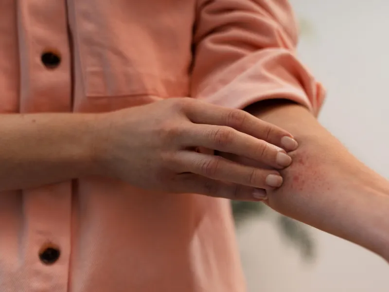 uma pessoa com prurido proveniente da dermatite seborreica a coçar-se