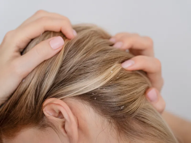 cabelo de mulher loira com sinais de caspa - dermatatite seborreica no couro cabeludo
