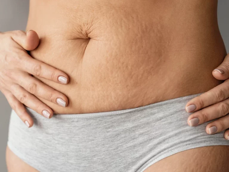 Estrias na barriga de uma mulher