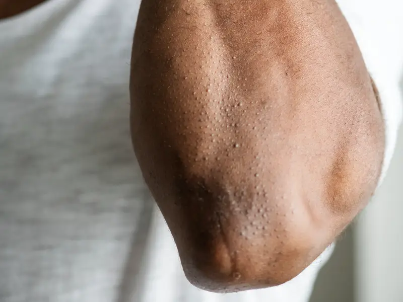 cotovelo com sinais de queratose pilar