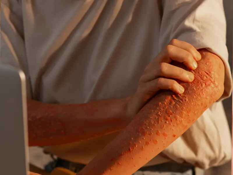 braço com reação à exposição solar