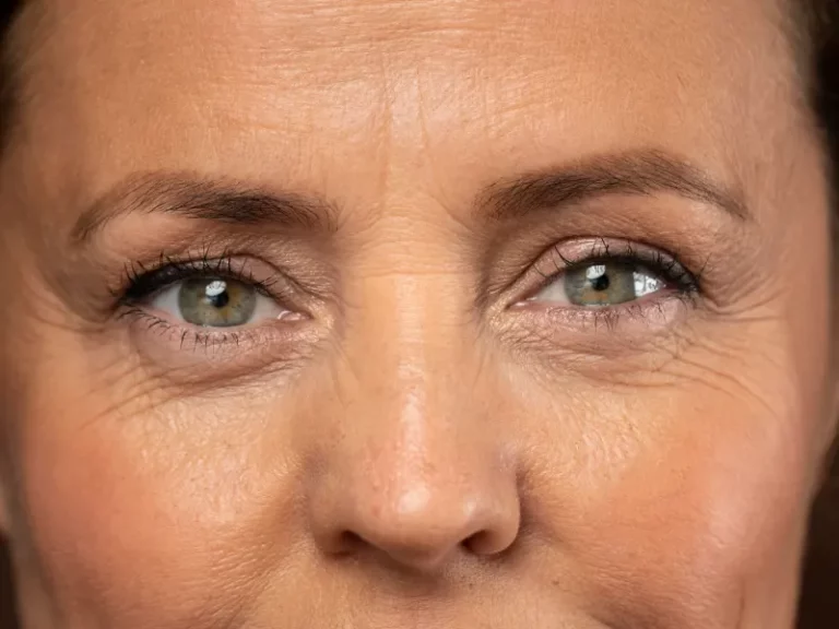 pés de galinha - rugas numa mulher